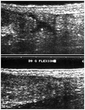 Sonographische Darstellung einer Achillesehnenruptur und vollständige Adaptation der Sehnenstümpfe bei 20° Plantarflektion.