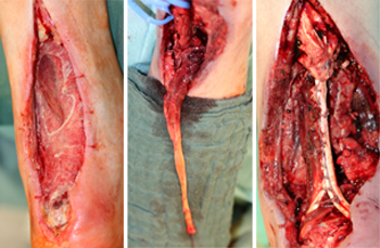 Infekt-Defekt-Situation nach offener Naht einer einfachen Achillessehnenruptur (links).  Heben der Flexor hallucis longus Sehne (Mitte) und Durchziehen durch den Fersenknochen (rechts).