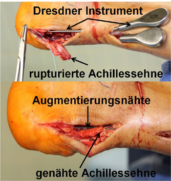 Offene Rekonstruktion der Achillessehne