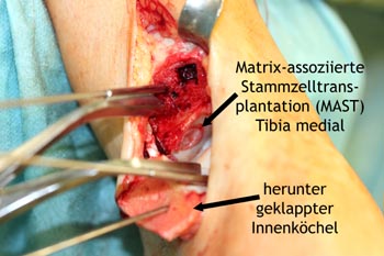 Matrix-assoziierte Stammzellentransplantation (MAST) Tibia medial mit Innenknöchelosteotomie