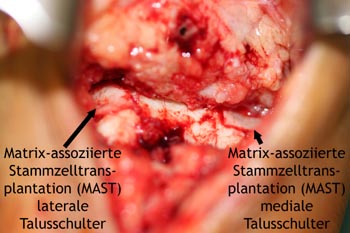Matrix-assoziierte Stammzellentransplantation (MAST) mediale und laterale Talusschulter