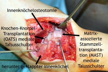 Matrix-assoziierte Stammzellentransplantation (MAST) und Knochen-Knorpel-Transplantation mediale Talusschulter mit Innenknöchelosteotomie.