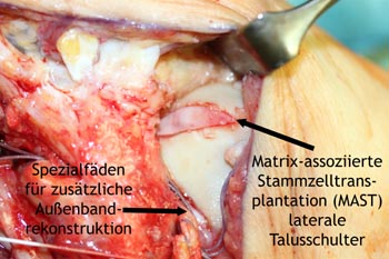 Matrix-assoziierte Stammzellentransplantation (MAST) laterale Talusschulter mit zusätzlicher komplexer Außenbandrekonstruktion.