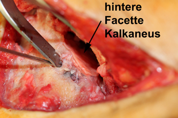 Matrix-assoziierte Stammzellentransplantation (MAST) hintere Facette des Subtalargelenks am Kalkaneus bei posttraumatischer Arthroes nach Kalkaneusfraktur