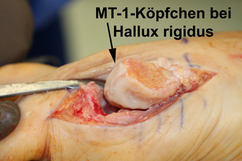 Matrix-assoziierte Stammzellentransplantation (MAST) am Metatarsale-1-Köpfchen bei Hallux rigidus Grad 3 zum Gelenkerhalt