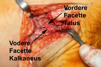 Matrix-assoziierte Stammzellentransplantation (MAST) der vorderen Facette des Subtalargelenks an Talus und Kalkaneus zum Gelenkerhalt nach Resektion einer talokalkanearen Koalition