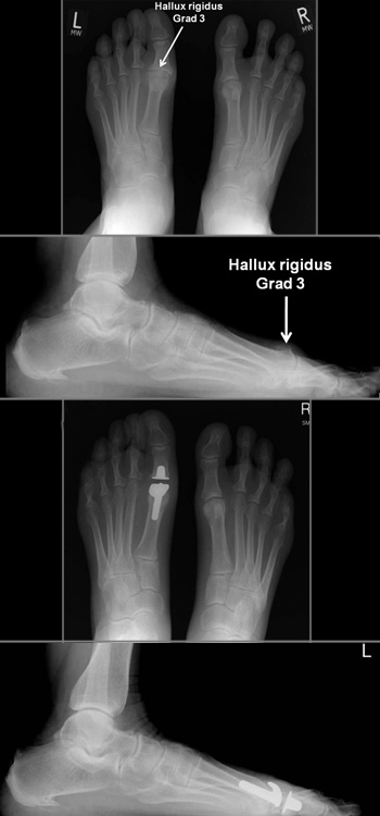 Hallux rigidus Stadium 3 (Aufgehobener Gelenkspalt) vor und nach Prothesenimplantation