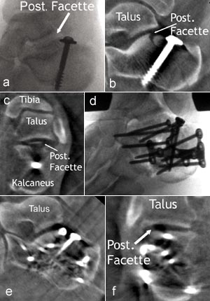 Zunächst geschlossene und später offene Reposition und interne Fixation einer Kalkaneusfraktur.