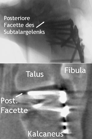 Offene Reposition über erweiterten lateralen Standardzugang und interne Fixation mit Plattenosteosynthese einer Kalkaneusfraktur. 