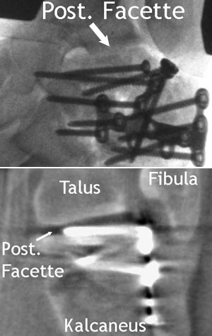 Offene Reposition über erweiterten lateralen Standardzugang und interne Fixation mit Plattenosteosynthese einer Kalkaneusfraktur.