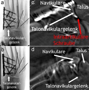 Homolaterale laterale Lisfranc-Luxationsfraktur mit kompletter Zerstörung der Kuneiforme 1.