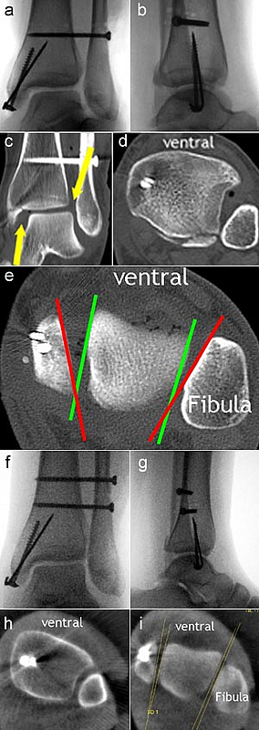 OSG-Luxationsfraktur Typ Weber-C, zunächst ohne intraoperative 3D-Röntgenbildgebung.