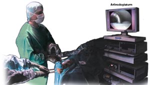 Arthroskopische Abschlussbeurteilung.