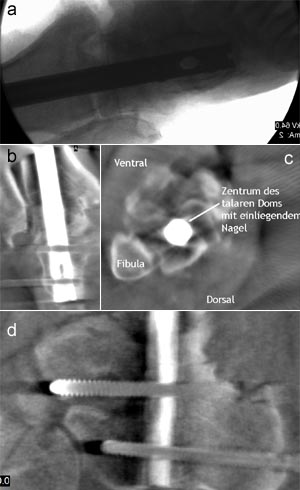 2D- und 3D-Bilder nach Nagelinsertion