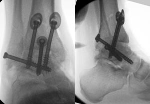 Aktueller Fall außerhalb der unten beschriebenen Studie mit speziellen Unterlegscheiben (Synthes, Umkirch), die bei schrägem Schraubeneintritt in die Tibia eine großflächige Auflage ermöglichen.