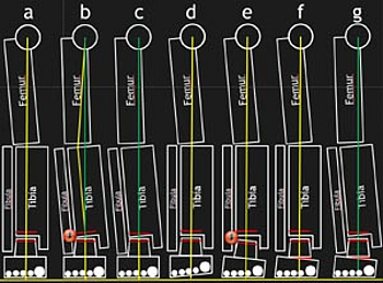 Prinzip der Ausrichtung der tibialen und talaren Komponente bei OSG-Endoprothesenimplantation.