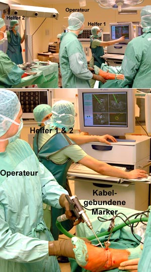 Weltweit erste navigierte retrograde Anbohrung einer Osteochondrosis dissecans (OCD) des Talus mit matchingfreier intraoperativer 3-D-Röntgenbildakquisitiion im Jahr 2004 durch den Prof. Martinus Richter. 