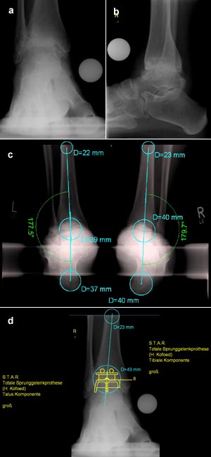 Analyse und Planung einer navigierten Implantation einer OSG Endoprothese (Modell STAR, SBI, Morrisville, USA) bei einem Fall ohne Achsenabweichung oder Deformität