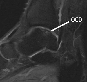 MRT OSG mit OCD mediale Talusschulter Stadium 2b nach Hepple und Winson mit intakter Knorpeloberfläche.