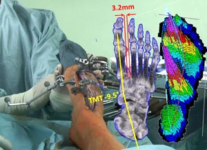 Holographische virtuelle Darstellung der Knochenposition und Kraftverteilung über dem Operationssitus bei einer Korrekturarthrodese des Mittelfußes/ Lisfrancgelenks.