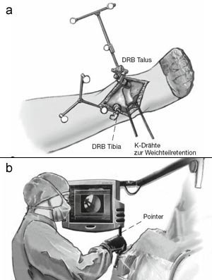 Platzierung der Dynamischen Referenz Basen (DRB) in die distale Tibia und den Talushals (Abbildung 4a).
