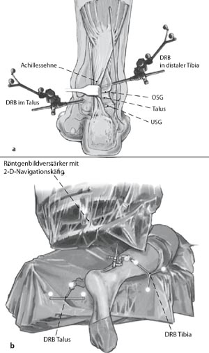 Platzierung der Dynamischen Referenz Basen (DRB) in distale Tibia über die initiale Inzision (Abbildung 4a).