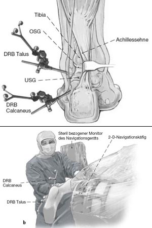 Platzierung der Dynamischen Referenz Basen (DRB) in den Talushals und in den Processus anterior calcanei über laterale Stichinzisionen