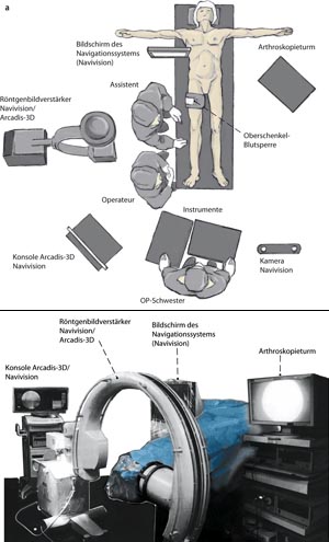 Lagerung des Patienten und Positionierung von Arthroskopieturm, Navigationssystem (Navivision) einschließlich BV (ARCADIS-3D) und Personal (Abbildung 4a). 