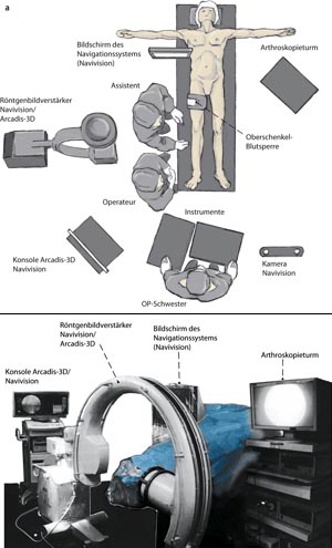 Lagerung des Patienten und Positionierung von Arthroskopieturm, Navigationssystem (Navivision) einschließlich BV (ARCADIS-3D) und Personal (Abbildung 4a).
