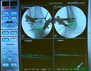 Festlegung der Achsen der beiden Knochen Tibia (blau) und Talus (grün), die im Verhältnis zueinander navigiert werden (links anteroposteriorer Strahlengang; rechts: seitlicher Strahlengang).