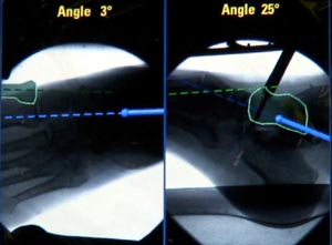 Festlegung der Achsen der beiden Knochen Talus (blau) und Metatarsale 1 (grün), die im Verhältnis zueinander navigiert werden (links dorsoplantarer Strahlengang; rechts: seitlicher Strahlengang). 