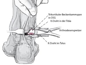 Festlegung der Achsen der beiden Knochen Tibia und Talus/Kalkaneus, die im Verhältnis zueinander navigiert werden (Abbildung 5a).