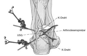 Darstellen des Subtalargelenks und Entknorpelung. Hierfür ggf. Einsetzen eines Arthrodenspreizers.