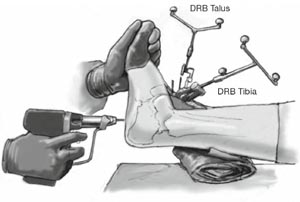 Navigationsgestützte Korrektur und Transfixation des Korrekturergebnisses mit 2 mm dicken Kirschnerdrähten.