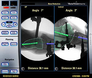 Navigationsgestützte Korrektur und Transfixation des Korrekturergebnisses mit 2,5 mm Kirschner-Drähten.