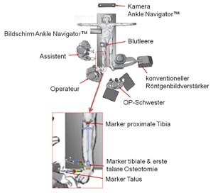 Lagerung des Patienten und Positionierung von Navigationssystem (Ankle Navigator) und Personal.