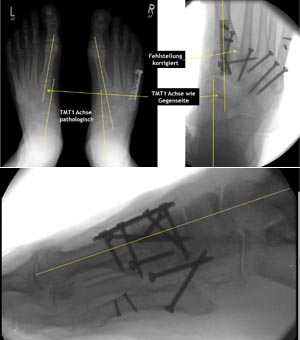 2D Bildakquisition Stellungskontrolle mit im Vergleich zur Gegenseite normalisierter Talo-Metatarsale-1-Achse (TMT) im dorsoplantaren (Abbildung 7a) und seitlichen Strahlengang (Abbildung 7b).