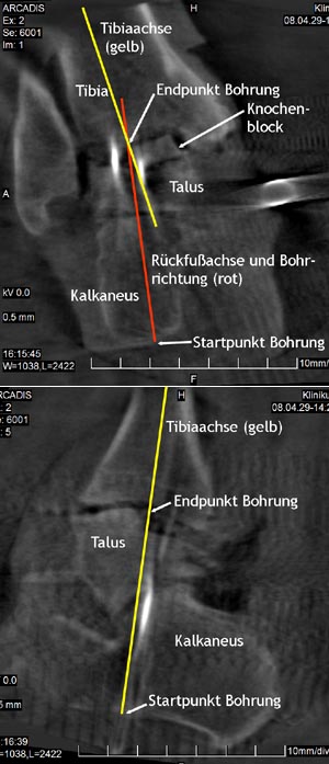 3D-Bildakquisition zur Analyse der Korrekturgenauigkeit und zur Planung des Bohrkanals für die Nagelinsertion 