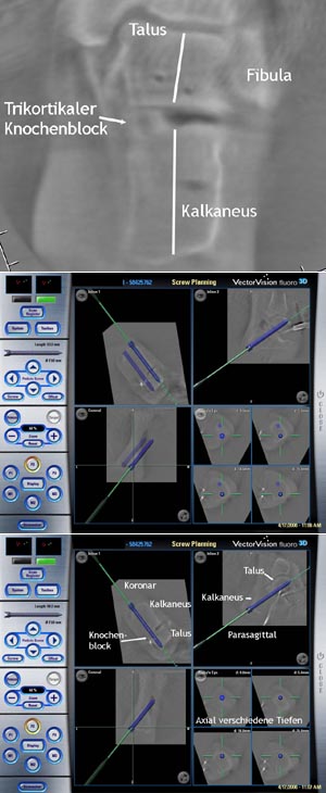 3D-Bildakquisition zur Analyse der Korrekturgenauigkeit (Abbildung 8a) und zur Planung des Bohrkanals für die Nagelinsertion (Abbildung 8b und Abbildung 8c).