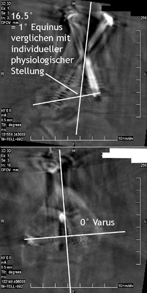 3D-Bilder nach Schraubeninsertion