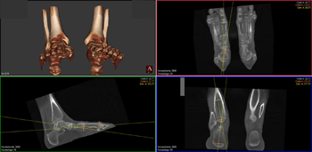 Beispiel für verschiedene Winkelmessungen im 3D-Datansatz des PedCAT