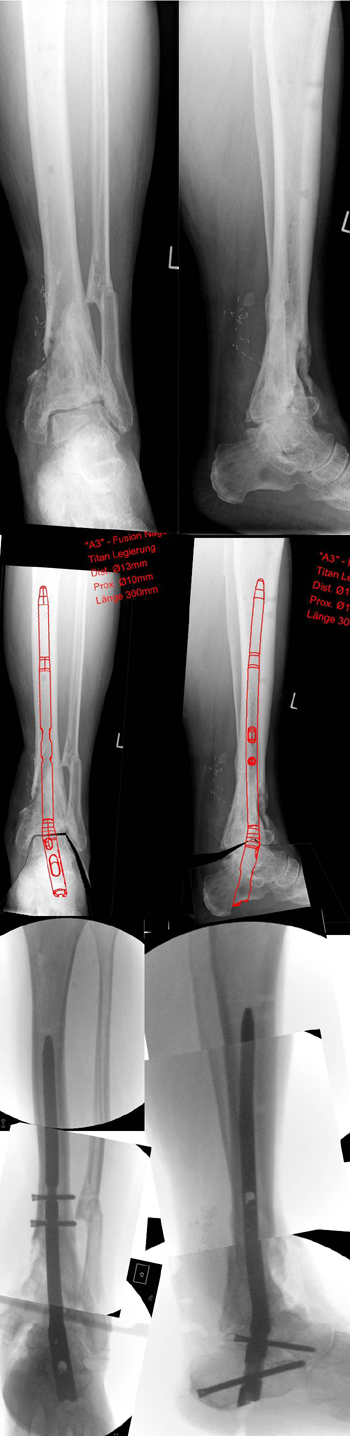 Planung einer Korrekturarthrodese des oberen uns unteren Sprunggelenks und Platzierung des A§-Nagels mit der Planungssoftware mediCAD und die Umsetzung der Planung.