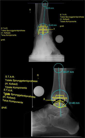 Planung einer OSG-Prothesenimplantation mit gleichzeitiger Korrektur mit der Planungssoftware mediCAD.