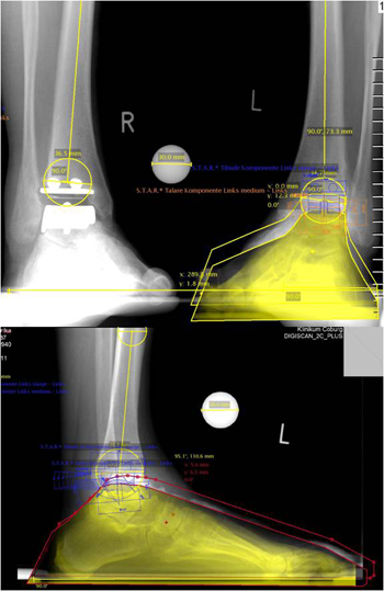 Planung einer OSG-Prothesenimplantation mit gleichzeitiger Korrektur mit der Planungssoftware Orthoplanner.