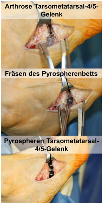 Implantation von Pyrospheren in die Tarsometatarsal-4 und -5-Gelenke