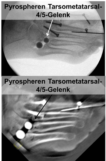 Implantierte Pyrospheren im Tarsometatarsal-4 und -5-Gelenk