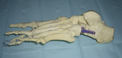 Modell zur Veranschaulichung einer Verlängerung der lateralen Fußsäule / Kalkaneus modifiziert nach Evans mit Knochentransplantat und Stabilisation mit R-Lock groß.