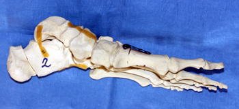 Modell mit Hohlfußkorrektur.  Korrekturosteotomie im Bereich der Ferse (im Bild links) mit Verschiebung nach außen und oben (proximal).  Fixierung mit Midfoot Fusion Bolts, die komplett innerhalb des Knochens liegen und nicht sichtbar sind.  Korrekturosteotomie im Bereich der 1. Mittelfußknochens (im Bild mittig und nach rechts) mit Verkippen des Knochens nach oben Richtung Fußrücken.  Fixierung mit einer polyaxialen winkelstabilen Platte (R-Lock, Platte oben sichtbar).