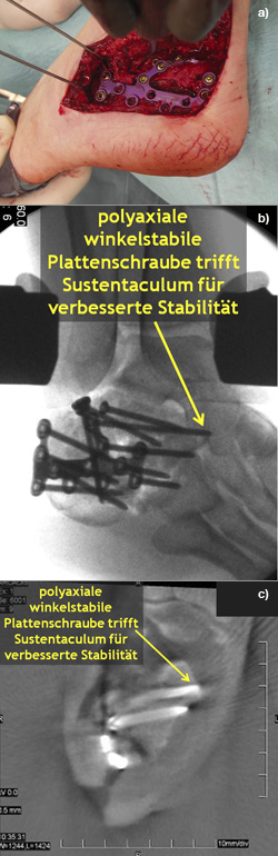 Offene Reposition und Plattenosteosynthese einer Kalkaneusfraktur über einen erweiterten lateral Zugang.