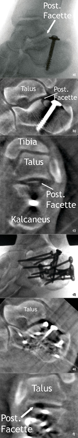 Zunächst geschlossene und später offene Reposition und interne Fixation einer Kalkaneusfraktur.